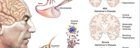 ویتامینی مفید برای بیماری آلزایمرز/ دکتر پرویز قدیریان