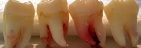 شناسایی سلول بنیادی در دندان عقل/ دکتر پرویز قدیریان