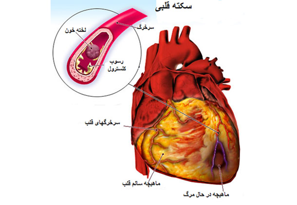 سکته‌ی قلبی/اکرم پدرام‌نیا