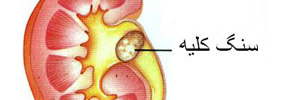 سنگ های کلیوی/ دکتر عطا انصاری