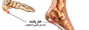 دردهای کف پا و خار پاشنه ای/ دکتر عطا انصاری