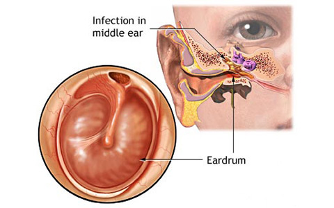 ear-infection