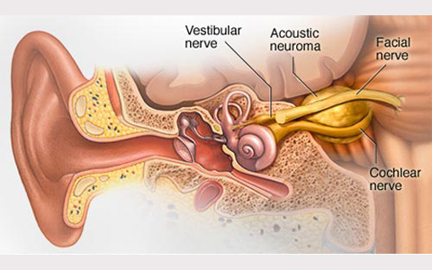 Acoustic-neuroma