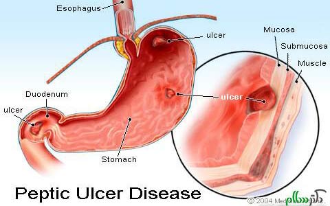زخم های معده و روده کوچک ـ۲/ دکتر عطا انصاری