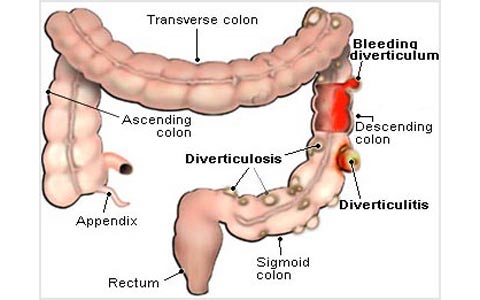 دیورتیکولیت چیست؟/دکتر عطا انصاری