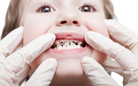 پوسیدگی یا کرم خوردگی دندان/دکتر عطا انصاری