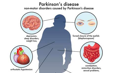 بیماری پارکینسون یا لقوه/بخش دوم/دکتر عطا انصاری