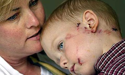 حمله ی کایوتی به پسر بچه ی سه ساله در ونکوور