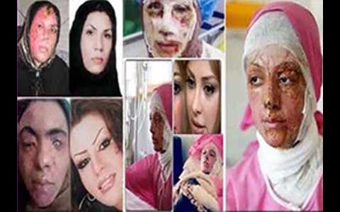 مختومه شدن پرونده اسیدپاشی‌های اصفهان بدون پیدا شدن متهم یا متهمان